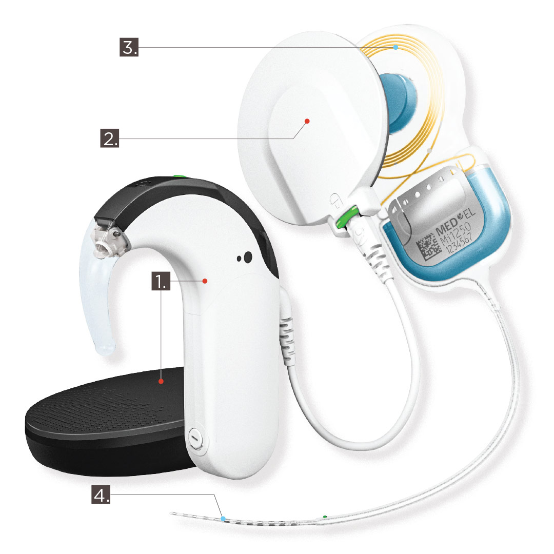 COCHLEAR IMPLANT ILLUSTRATION
