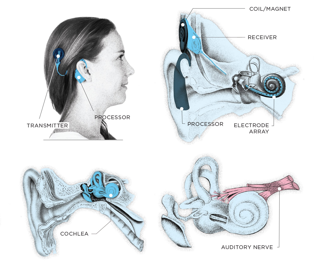 COCHLEAR IMPLANT ILLUSTRATION